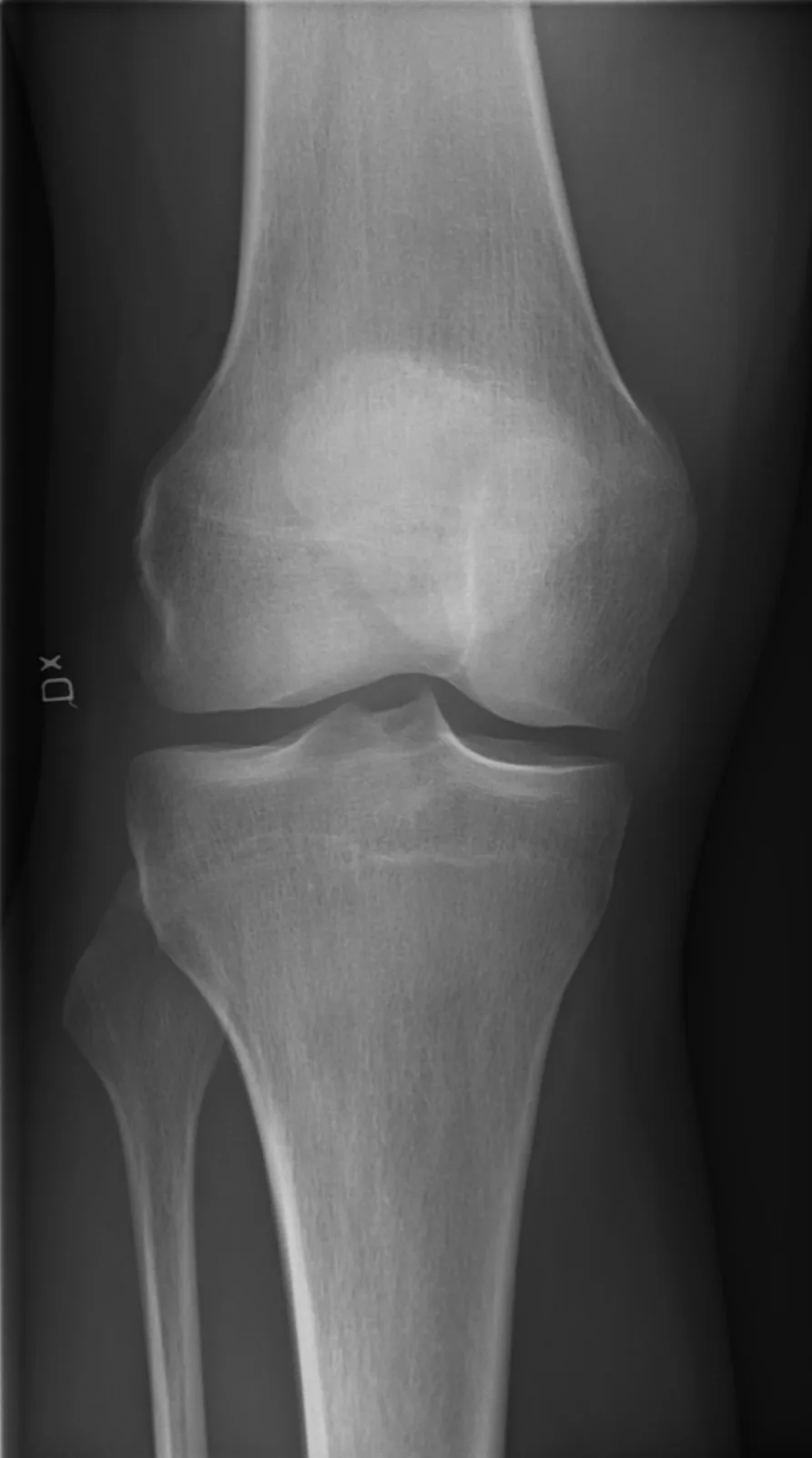 Post-operative X-ray film of a knee, front (AP) view, from the practice