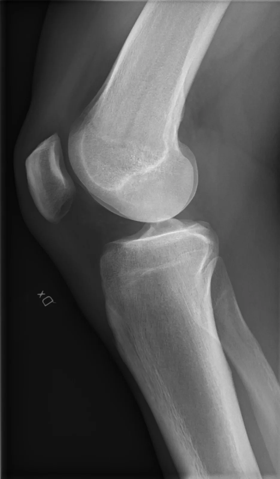 Post-operative X-ray film of a knee, lateral view, from the practice
